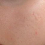 acne scars on cheeks after