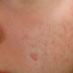 acne scars on cheeks before