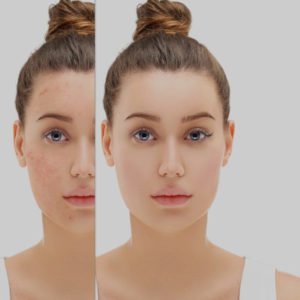 How to reduce deep acne scars | Kingsway Dermatology