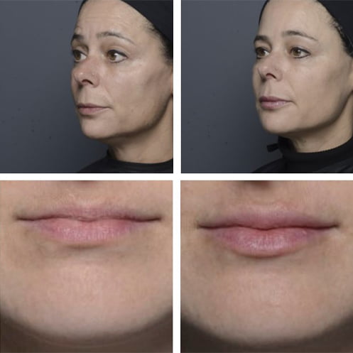 Dermal Filler Before and After Treatment in Toronto
