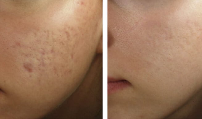 Acne and Acne Scar Treatment in Eobicoke