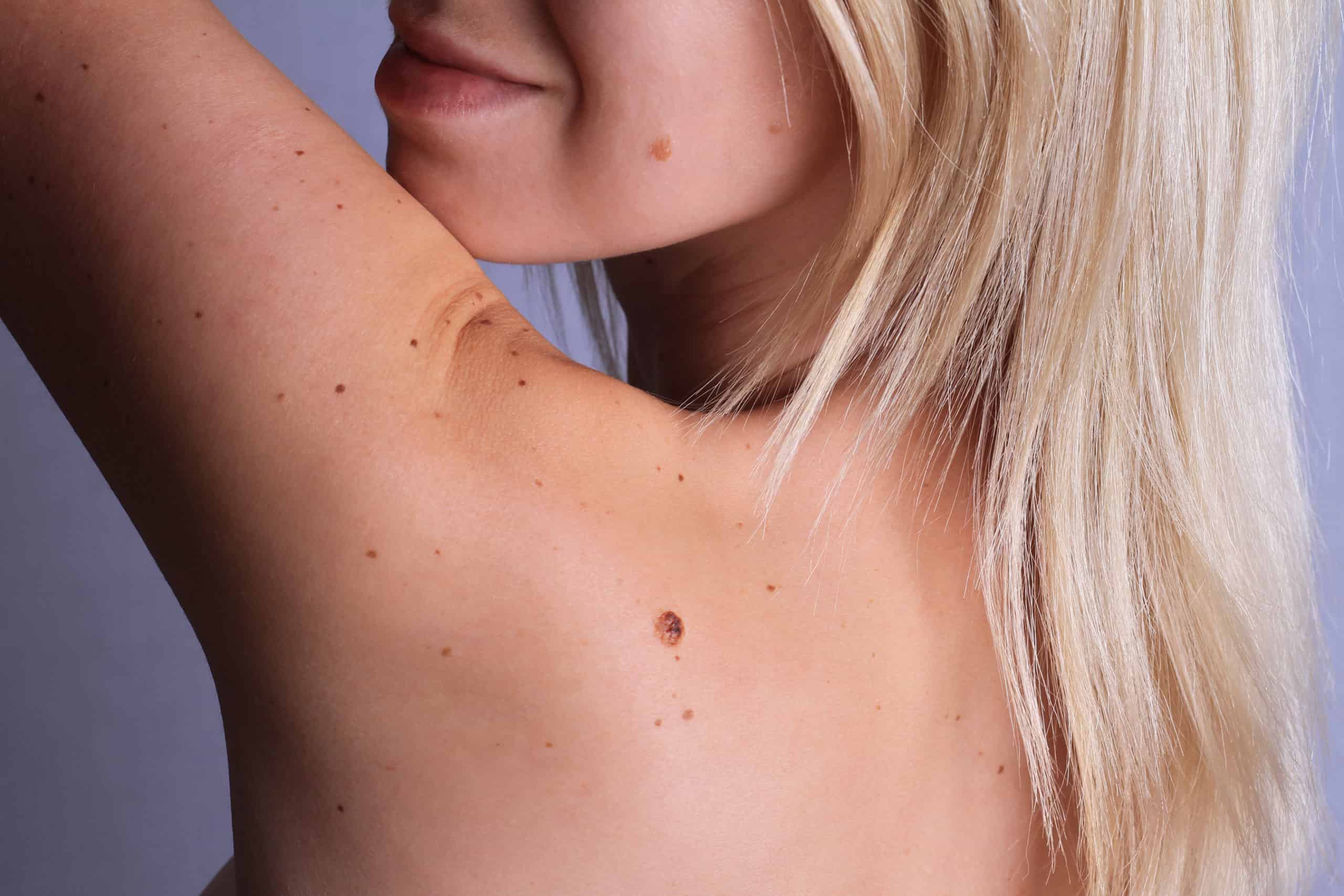 Mole and Skin Tag Removal in Toronto