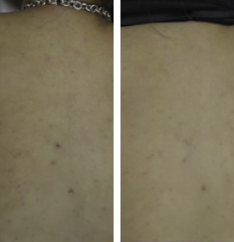 Peels with Microneedling Treatment
