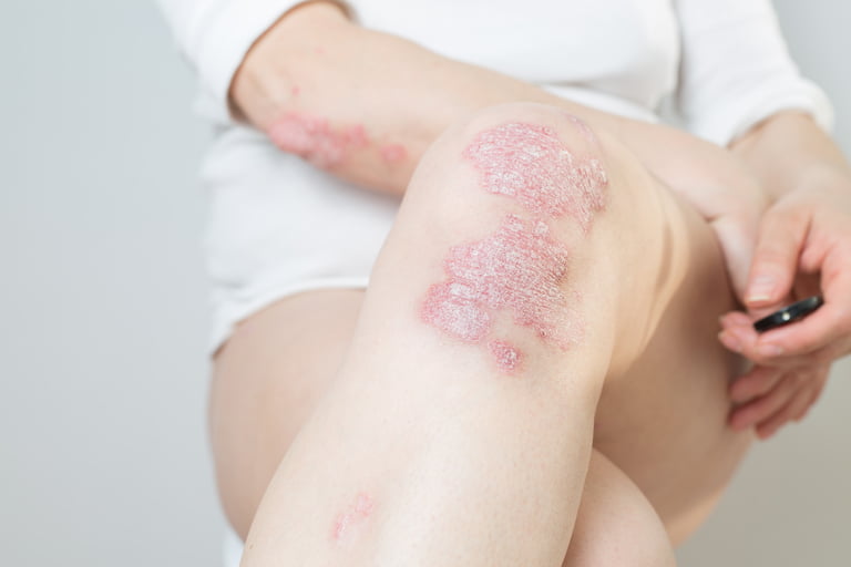 eczema and psoriasis treatment in Toronto