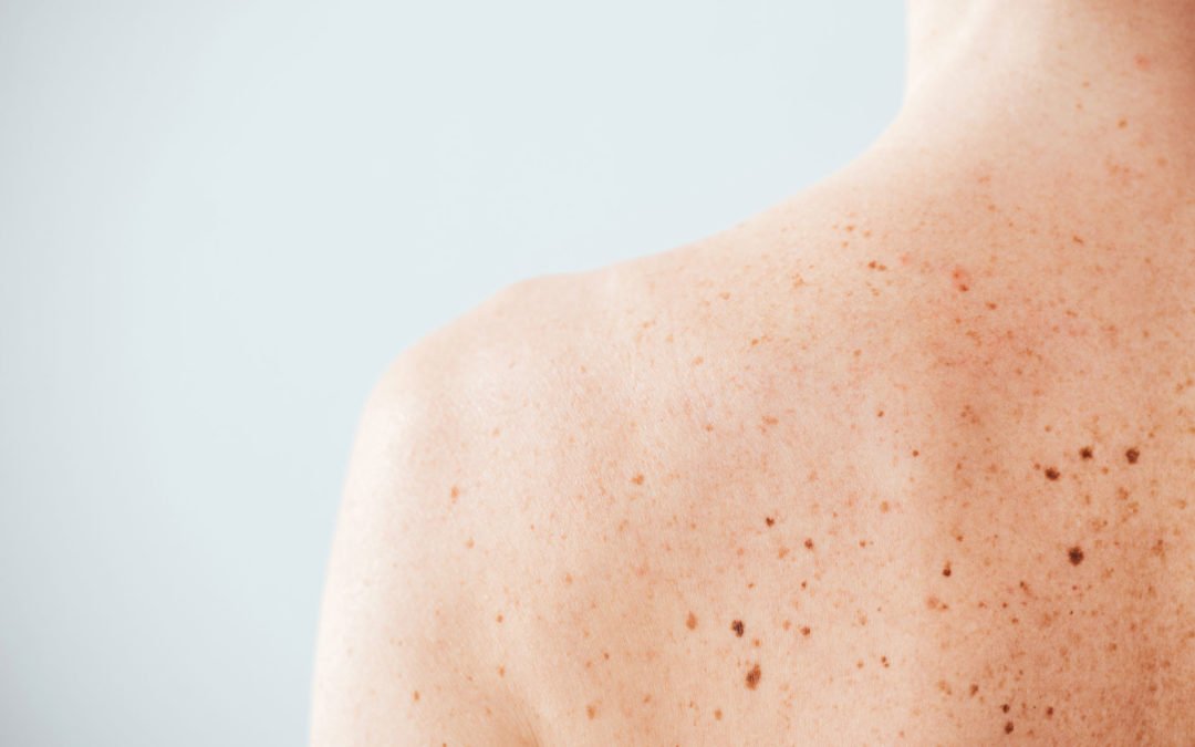 How do I know if a mole is worrisome? Understanding Melanoma