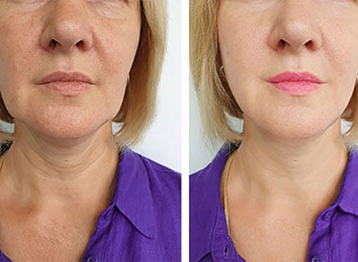 Microneedling and Collagen Treatment before and after