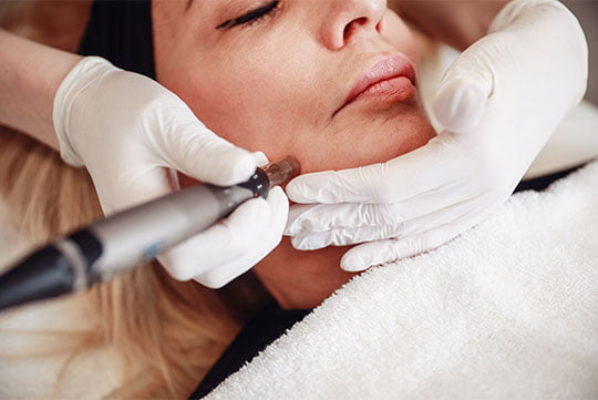 Microneedling and Collagen Treatment with patient