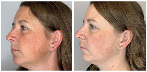 Bela MD+ Microdermabrasion treatment before and after