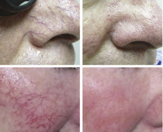 Excel V laser treatment before and after results at Kingsway Dermatology in Toronto
