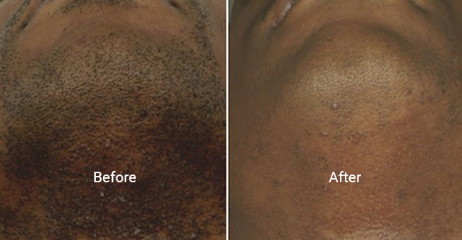Laser hair removal before and after results at Kingsway Dermatology in Toronto