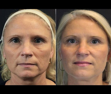 InstaLift before and after at Kingsway Dermatology