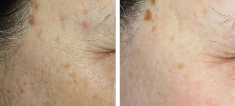 IPL before and after treatment at Kingsway Dermatology