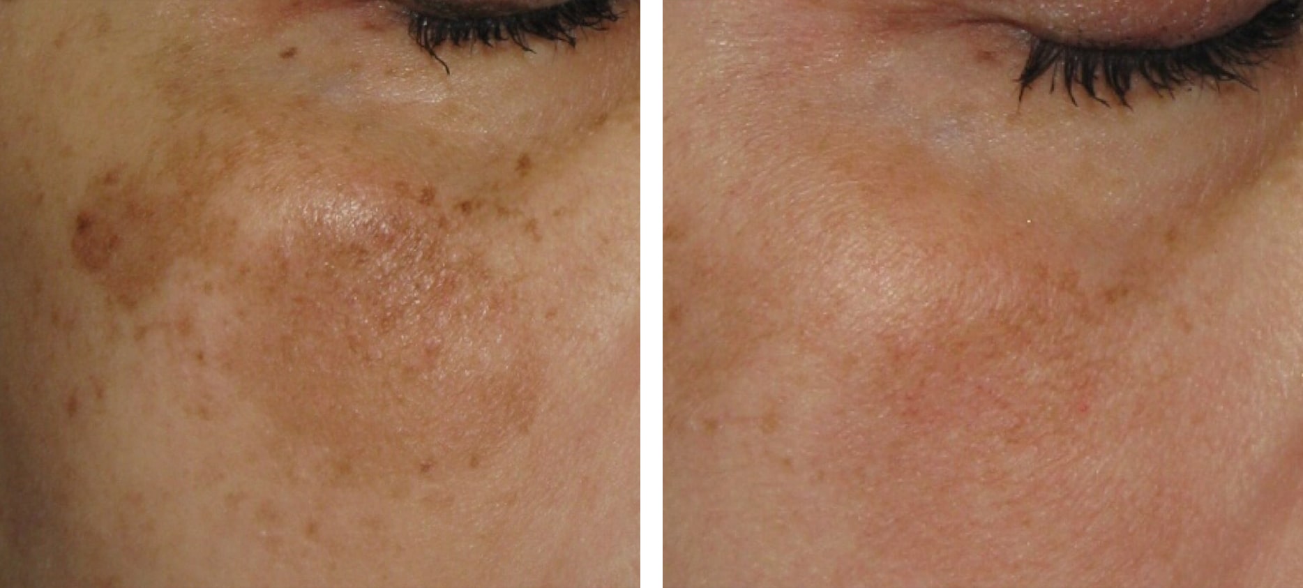 IPL before and after treatment at Kingsway Dermatology