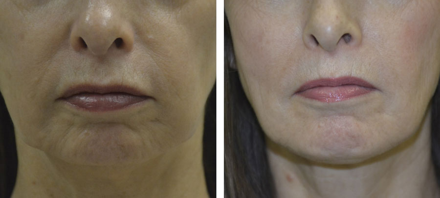 Ultherapy treatment before and after at Kingsway Dermatology