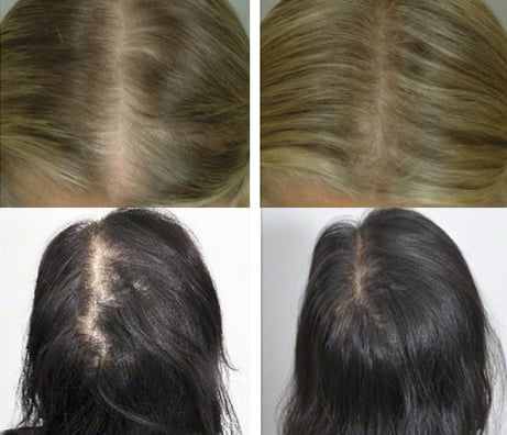 Hair Loss before and after treatment