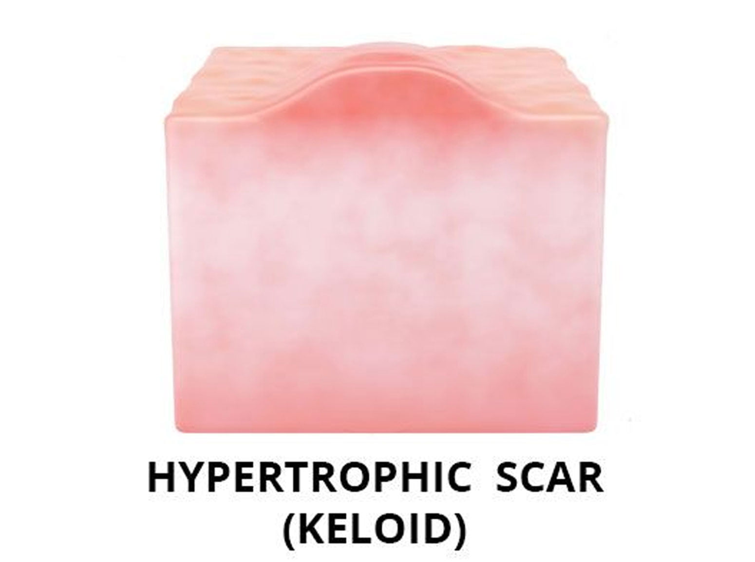 Keloid scar