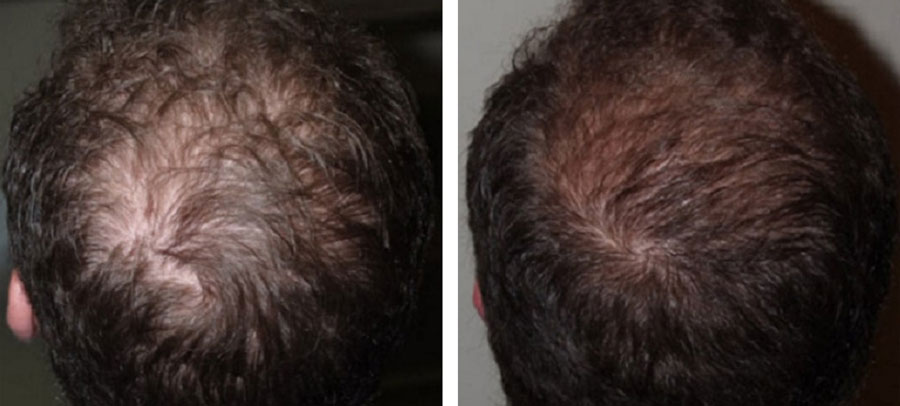 Before and After Platelet Rich Plasma Therapy