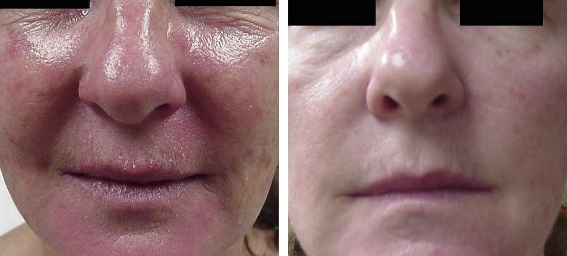 Rosacea before and after treatment at Kingsway Dermatology