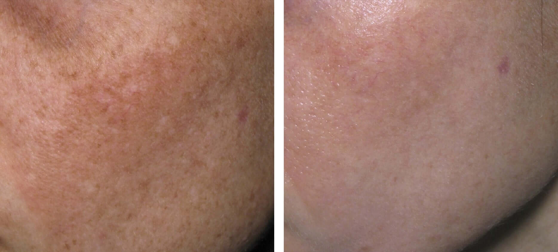 Skin pigmentation treatment before and after at Kingsway Dermatology