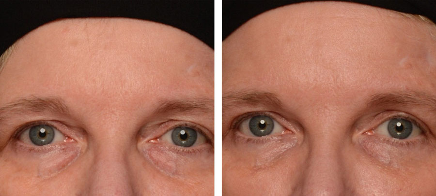 Eye Enhancement before and after at Kingsway Dermatology
