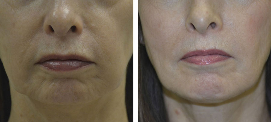Jowls before and after treatment at Kingsway Dermatology