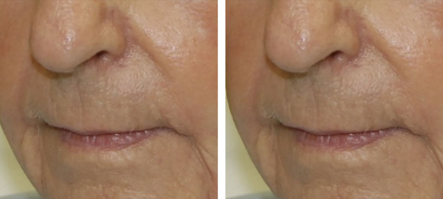 Lines and wrinkles treatment before and after