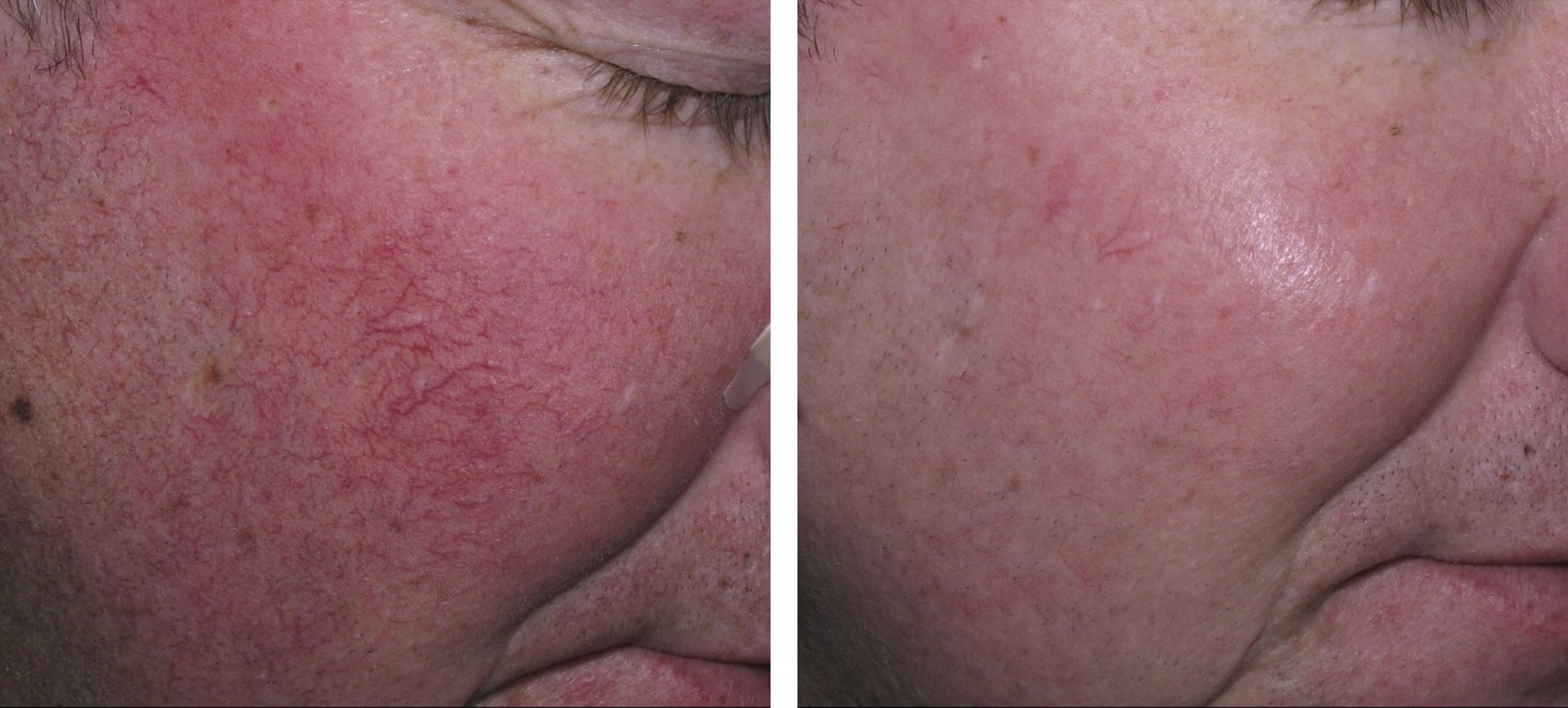 Rosacea before and after treatment at Kingsway Dermatology
