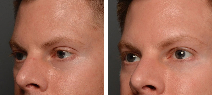 Eye Enhancement before and after at Kingsway Dermatology
