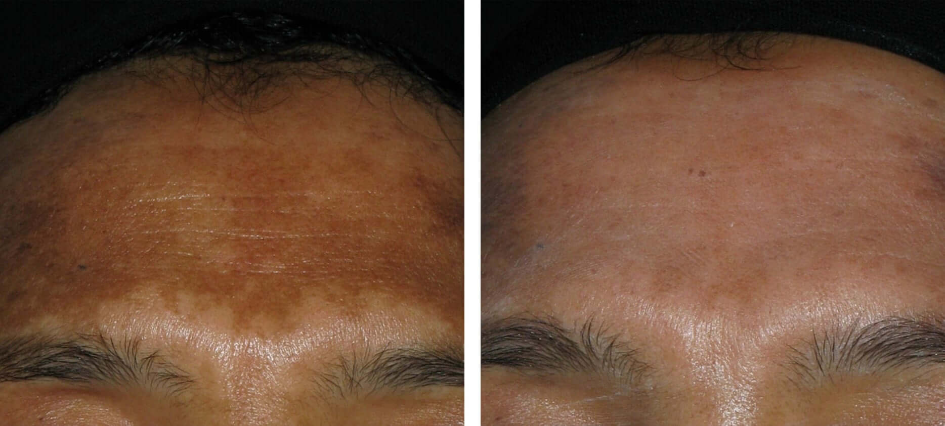 Skin pigmentation treatment before and after at Kingsway Dermatology