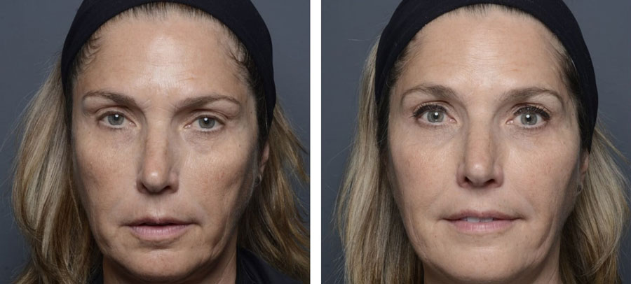 Before and After Volume Loss at Kingsway Dermatology
