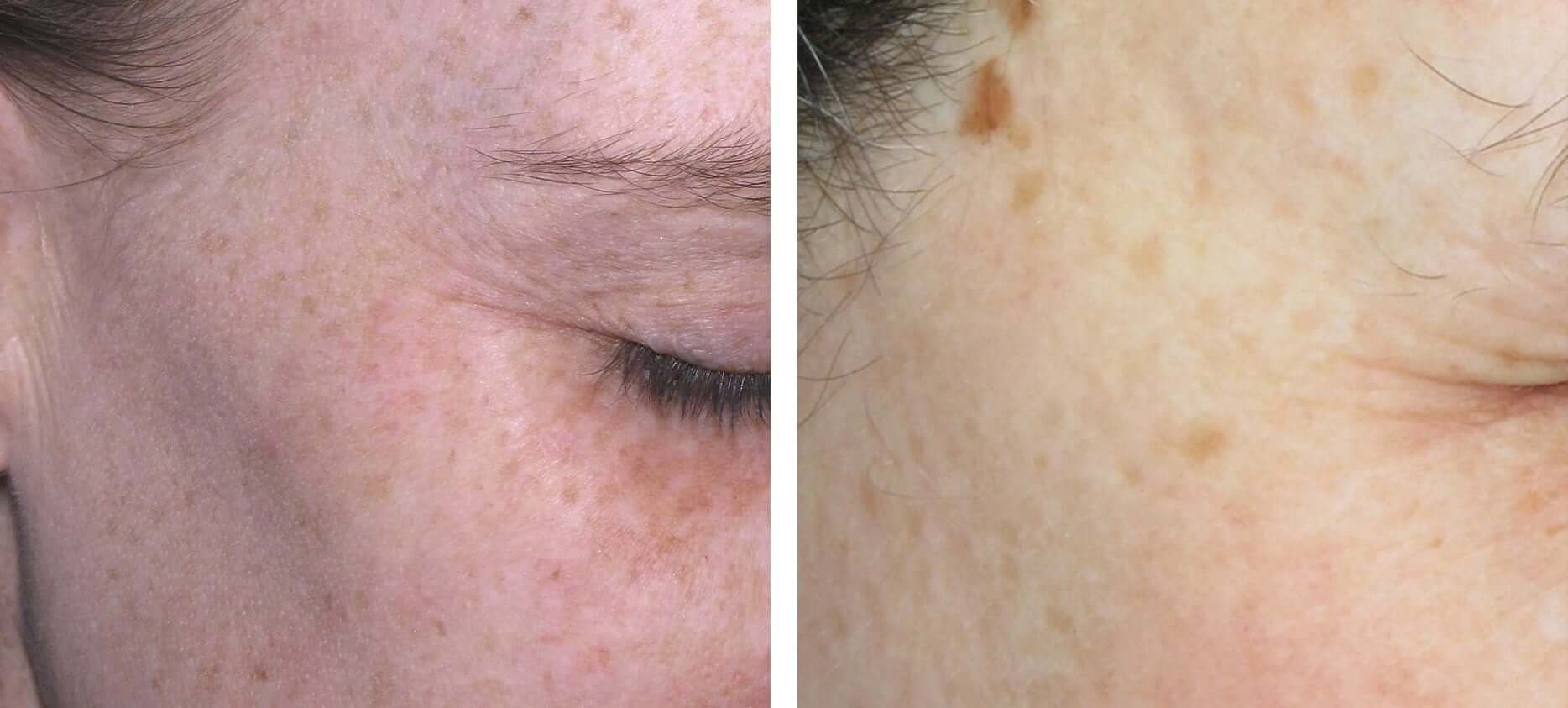 Brown Spots Before & After