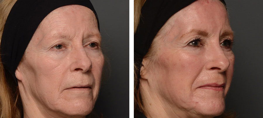 Cheek laser skin resurfacing before and after at Kingsway Dermatology