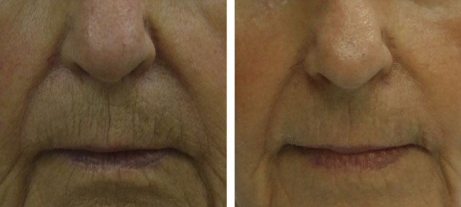 Cheek laser skin resurfacing before and after at Kingsway Dermatology