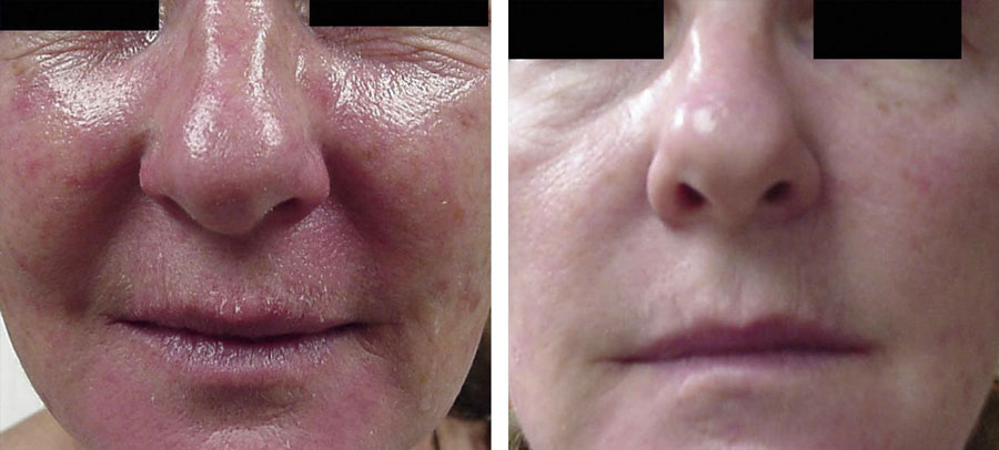 Laser genesis treatment before and after