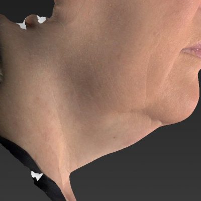 1 Belkyra Chin Reduction After Left Side