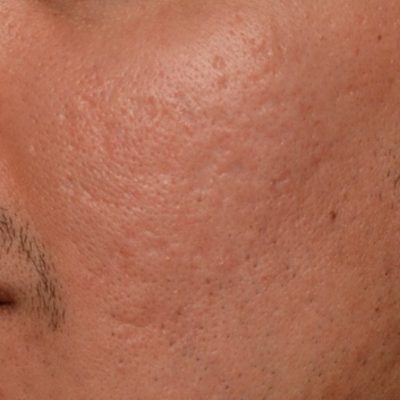 Acne Scars After Fractional Laser Resurfacing from Kingsway Dermatology