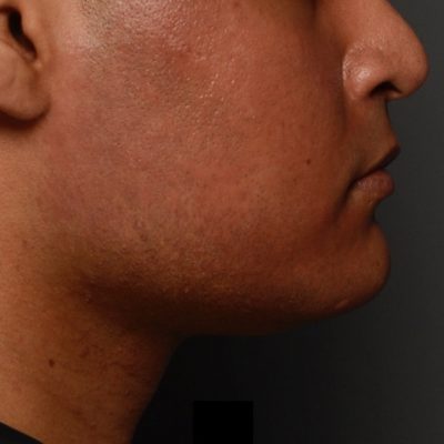 Before Jawline and Chin Filler Kingsway Dermatology