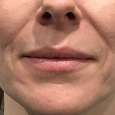 After Dermal Lip Filler from Kingsway Dermatology