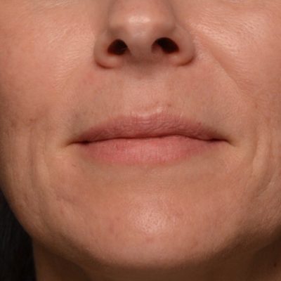 Before Dermal Lip Filler from Kingsway Dermatology