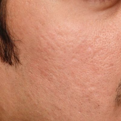 Acne Scars After Fractional Laser Resurfacing from Kingsway Dermatology 2