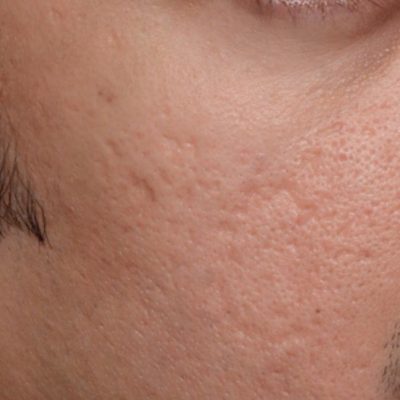Acne Scars Before Fractional Laser Resurfacing from Kingsway Dermatology 2