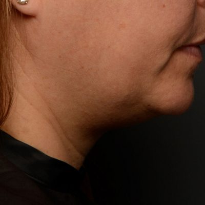 3-Belkyra-Chin-Reduction-Right-Side-After