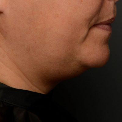 3-Belkyra-Chin-Reduction-Right-Side-Before