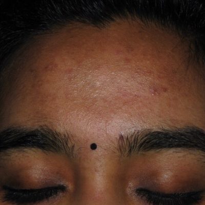 Acne Scars After Fractional Laser Resurfacing from Kingsway Dermatology 3