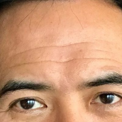 Before Filler for Forehead Lines Kingsway Dermatology 1