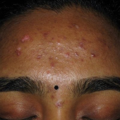 Acne Scars Before Fractional Laser Resurfacing from Kingsway Dermatology 3