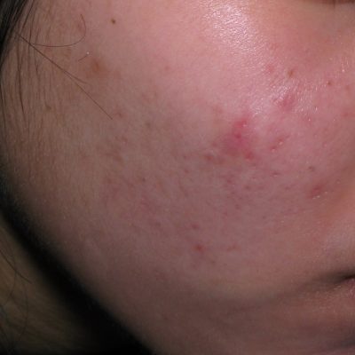 4 months post pigmented Acne Scars after