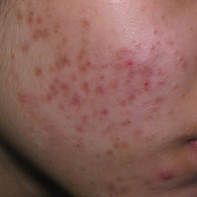 4 months post pigmented Acne Scars before