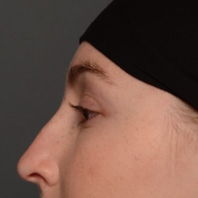 After Non-Surgical Nose Augmentation from Kingsway Dermatology
