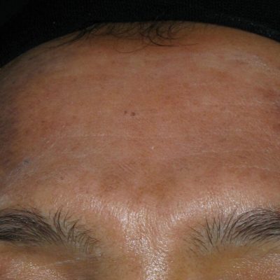 After Laser Pigmentation from Kingsway Dermatology 5
